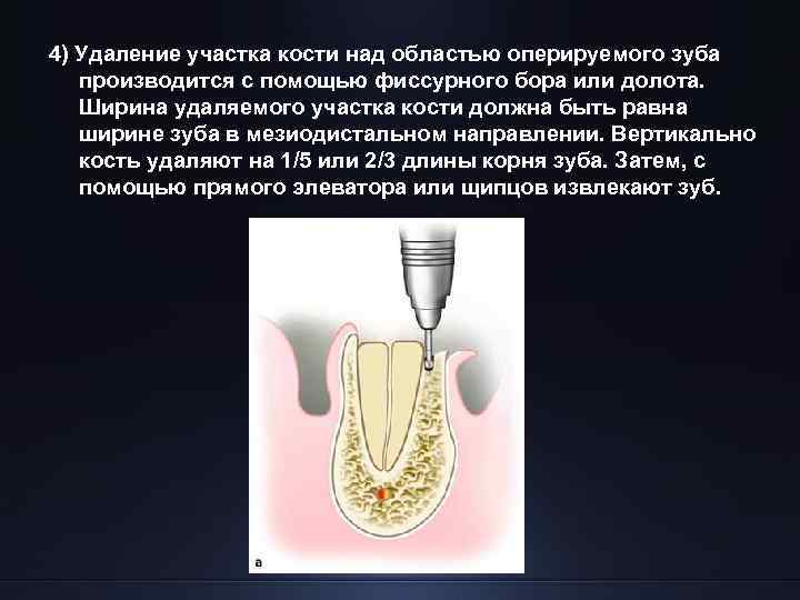 4) Удаление участка кости над областью оперируемого зуба производится с помощью фиссурного бора или