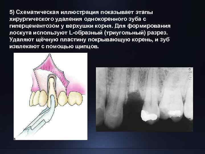 5) Схематическая иллюстрация показывает этапы хирургического удаления однокоренного зуба с гиперцементозом у верхушки корня.