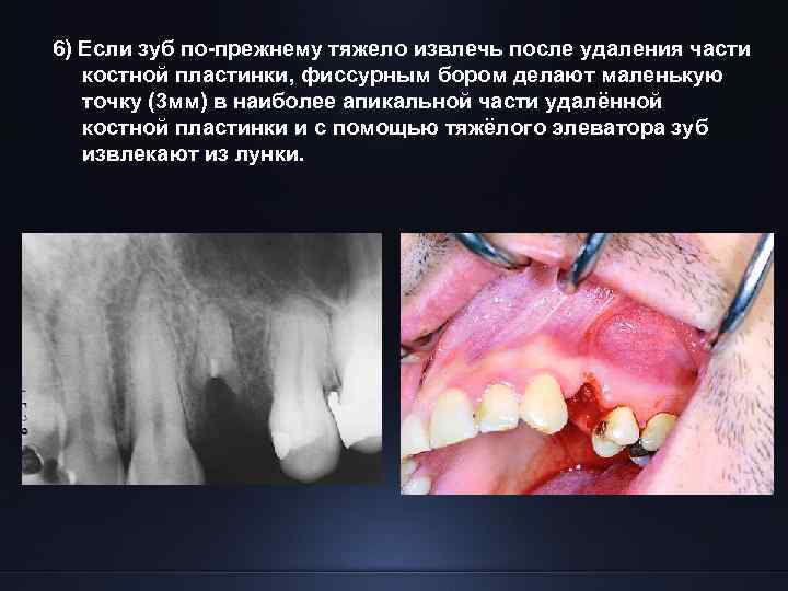 6) Если зуб по-прежнему тяжело извлечь после удаления части костной пластинки, фиссурным бором делают