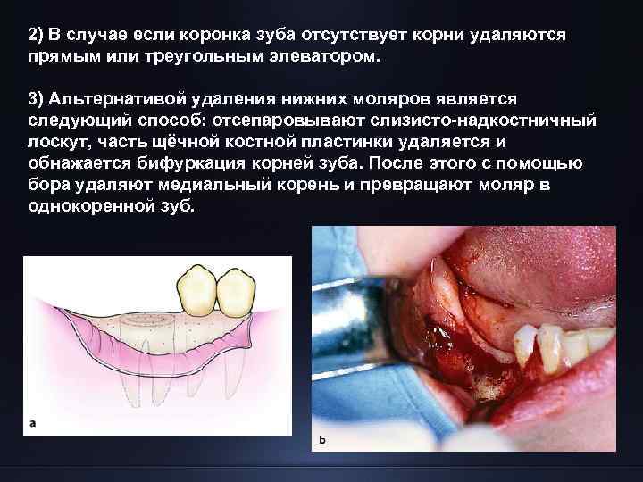 2) В случае если коронка зуба отсутствует корни удаляются прямым или треугольным элеватором. 3)