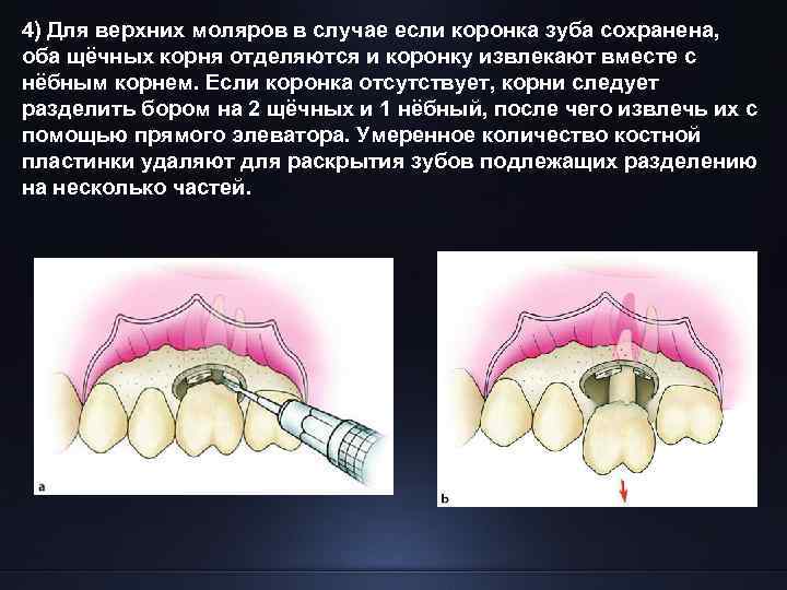 4) Для верхних моляров в случае если коронка зуба сохранена, оба щёчных корня отделяются