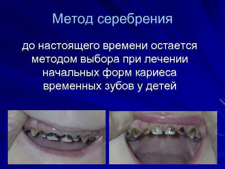 Метод серебрения до настоящего времени остается методом выбора при лечении начальных форм кариеса временных
