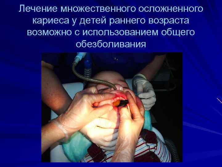 Лечение множественного осложненного кариеса у детей раннего возраста возможно с использованием общего обезболивания 