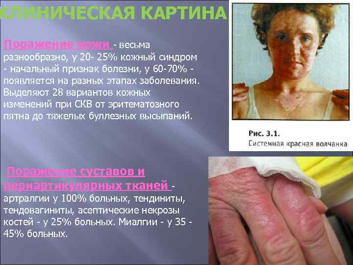 КЛИНИЧЕСКАЯ КАРТИНА Поражение кожи - весьма разнообразно, у 20 - 25% кожный синдром -