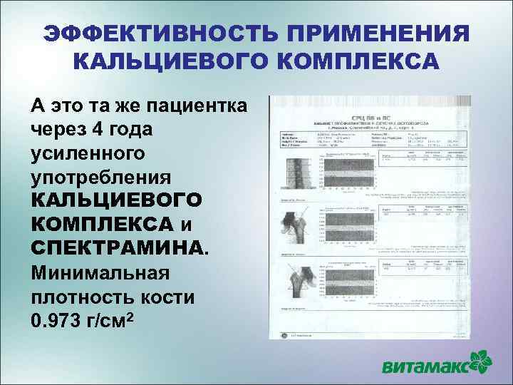 ЭФФЕКТИВНОСТЬ ПРИМЕНЕНИЯ КАЛЬЦИЕВОГО КОМПЛЕКСА А это та же пациентка через 4 года усиленного употребления
