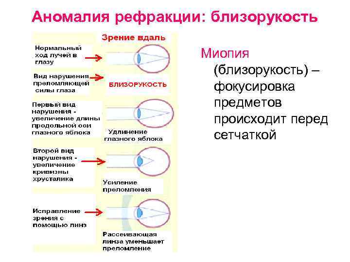 Аномалия рефракции: близорукость Миопия (близорукость) – фокусировка предметов происходит перед сетчаткой 