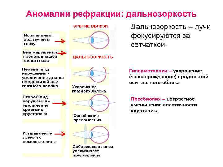 Аномалии рефракции: дальнозоркость Дальнозоркость – лучи фокусируются за сетчаткой. Гиперметропия – укорочение (чаще врожденное)