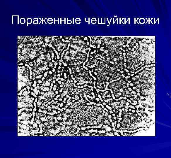 Пораженные чешуйки кожи 