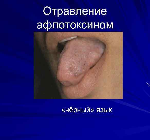 Отравление афлотоксином «чёрный» язык 