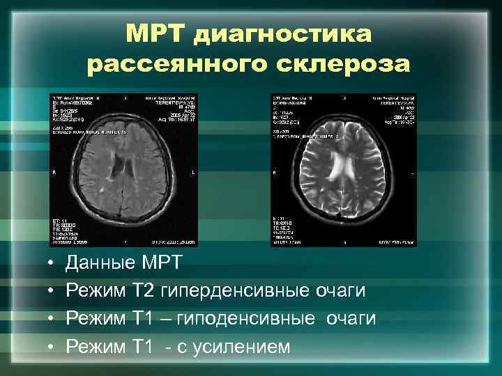 Рассеянный склероз мрт картина