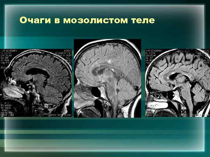 Очаги в мозолистом теле 