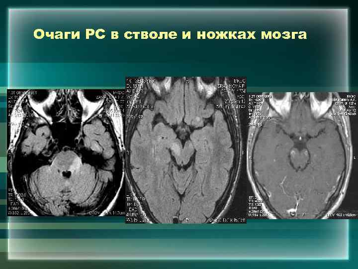 Очаги РС в стволе и ножках мозга 
