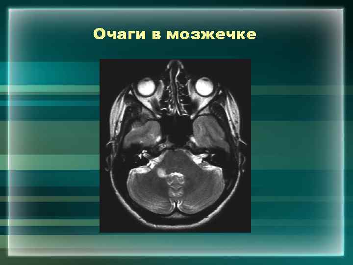 Очаги в мозжечке 