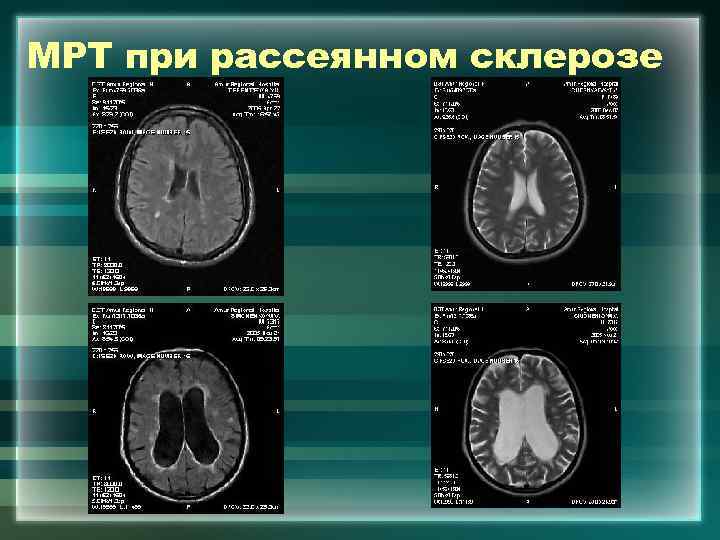 Рассеянный склероз мрт картина