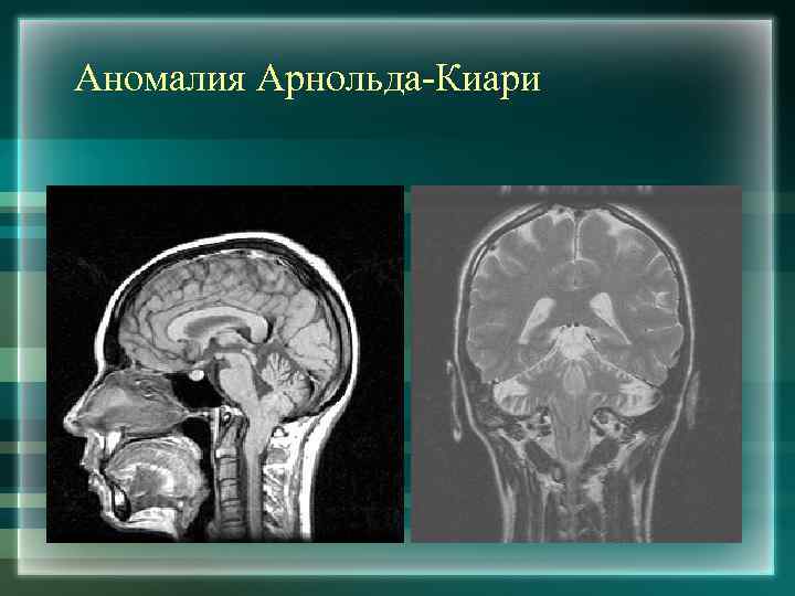 Аномалия Арнольда-Киари 