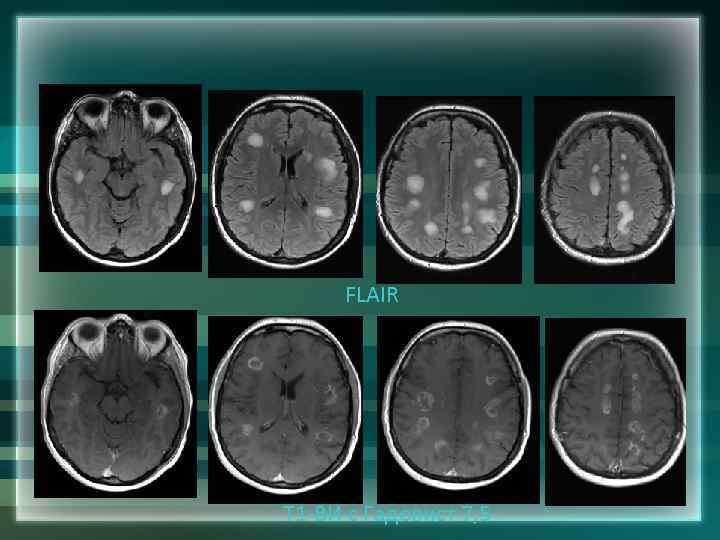 FLAIR Т 1 -ВИ с Гадовист 7, 5 