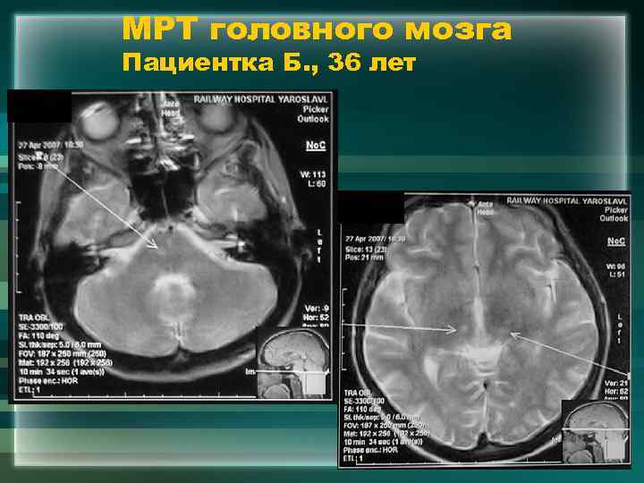 МРТ головного мозга Пациентка Б. , 36 лет 