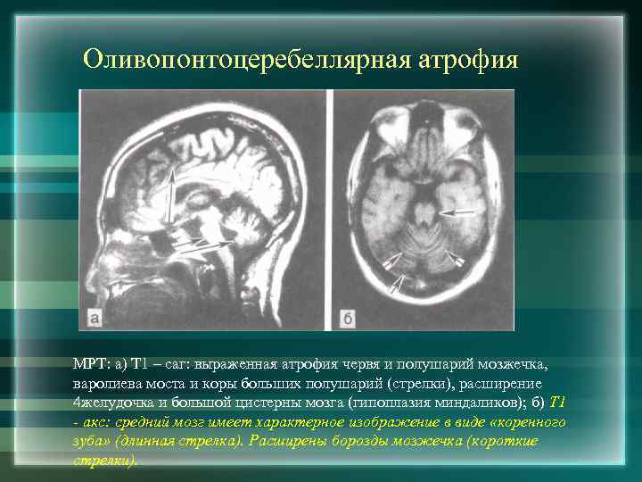 Рассеянный склероз мрт картина