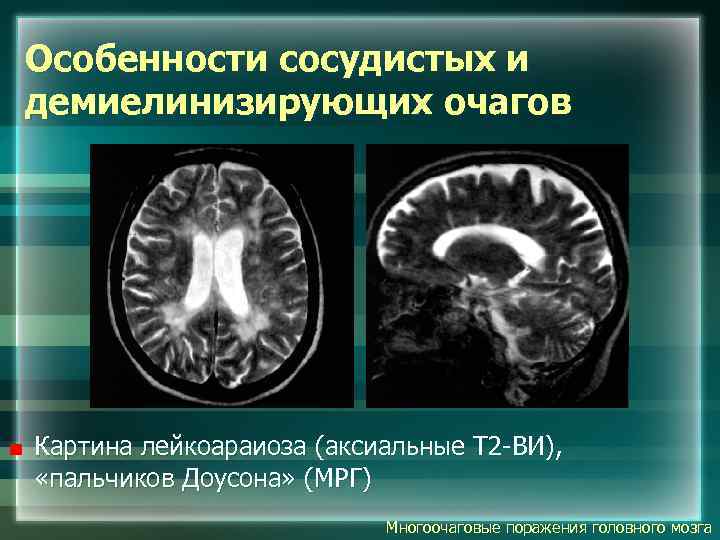 Картина единичных очаговых изменений вещества мозга сосудистого характера