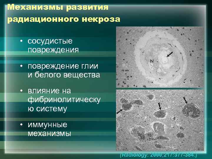 Механизмы развития радиационного некроза • сосудистые повреждения • повреждение глии и белого вещества •