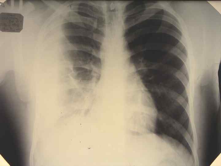 ОПОРНЫЕ ДИАГНОСТИЧЕСКИЕ ПРИЗНАКИ  ЛЕГОЧНОГО ВОСПАЛЕНИЯ В РАМКАХ  CLAMYDIA-PSITTACI – ИНФЕКЦИИ ü 