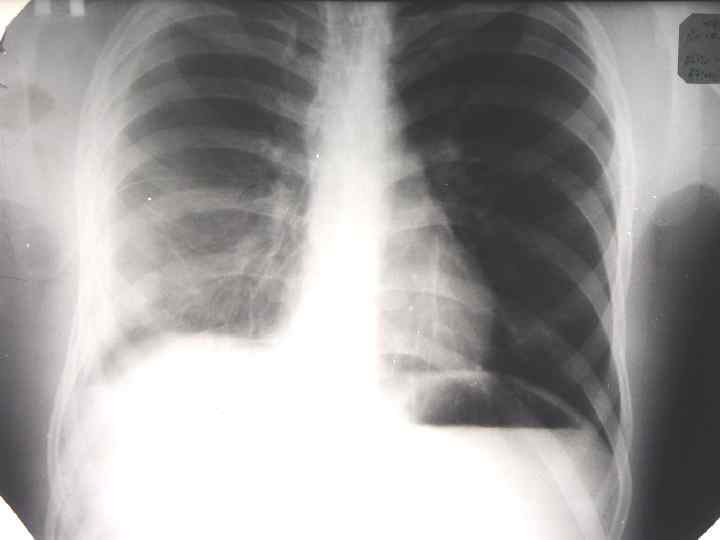   ОПОРНЫЕ ДИАГНОСТИЧЕСКИЕ ПРИЗНАКИ ЛЕГОЧНОГО ВОСПАЛЕНИЯ В РАМКАХ ЛЕГИОНЕЛЛЕЗНОЙ ИНФЕКЦИИ ü  ЭПИДЕМИОЛОГИЧЕСКИЙ
