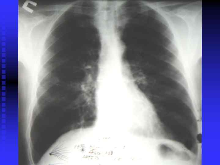   КРИТЕРИИ ТЯЖЕЛОГО ТЕЧЕНИЯ  ПНЕВМОНИЙ n  ДВУСТОРОННЯЯ ИЛИ МНОГОДОЛЕВАЯ ИНФИЛЬТРАЦИЯ ЛЕГОЧНОЙ