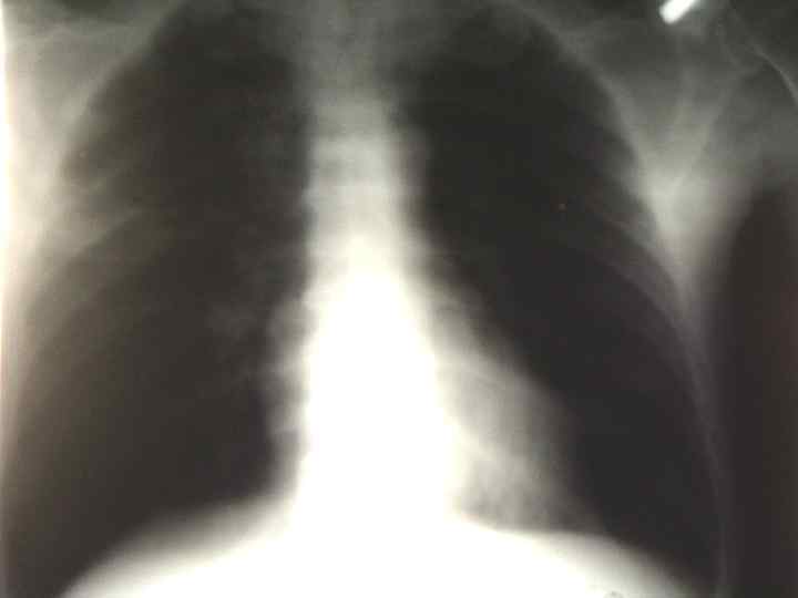  ВНЕБОЛЬНИЧНАЯ ПНЕВМОНИЯ: ИСХОДНАЯ ДИАГНОСТИЧЕСКАЯ КЛАССИФИКАЦИЯ  (ЕВРОПЕЙСКОЕ РЕСПИРАТОРНОЕ ОБЩЕСТВО)  n  НЕТЯЖЕЛАЯ