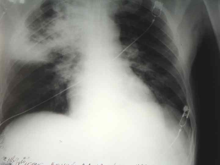 ОСОБЕННОСТИ ТЕЧЕНИЯ ПНЕВМОНИЙ  У ПОЖИЛЫХ ЛЮДЕЙ Непостоянные и часто невыраженные физикальные признаки заболевания