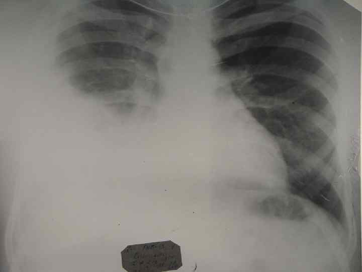 ОПОРНЫЕ ДИАГНОСТИЧЕСКИЕ ПРИЗНАКИ  ЛЕГОЧНОГО ВОСПАЛЕНИЯ В РАМКАХ MYCOPLASMA PNEUMONIAE - ИНФЕКЦИИ Ø 