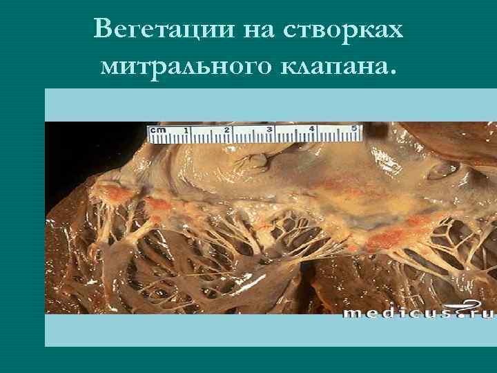 Вегетации на створках митрального клапана. 