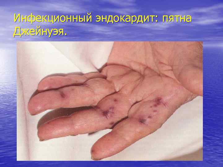Инфекционный эндокардит: пятна Джейнуэя. 