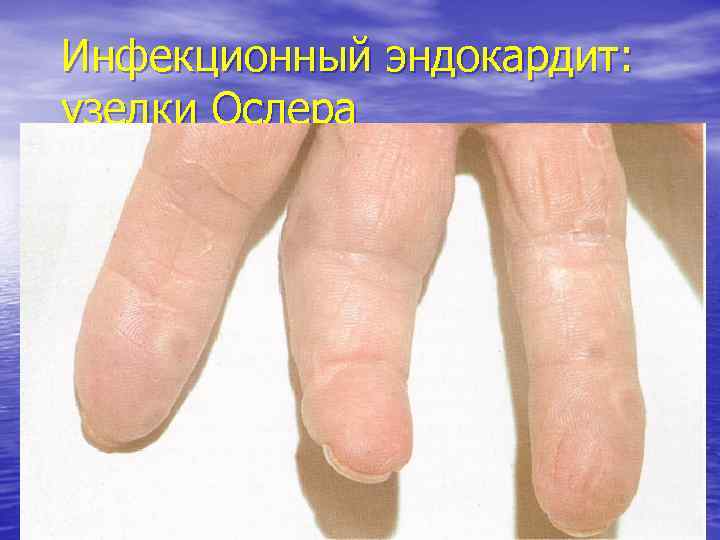 Инфекционный эндокардит: узелки Ослера 