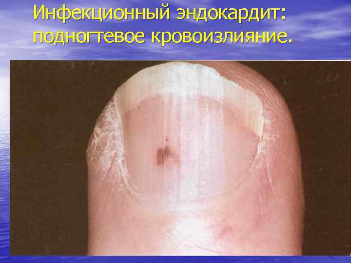 Инфекционный эндокардит: подногтевое кровоизлияние. 