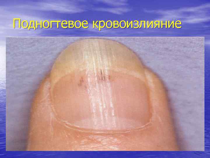 Подногтевое кровоизлияние 