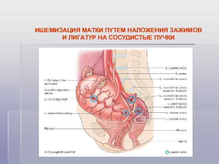 ИШЕМИЗАЦИЯ МАТКИ ПУТЕМ НАЛОЖЕНИЯ ЗАЖИМОВ И ЛИГАТУР НА СОСУДИСТЫЕ ПУЧКИ 