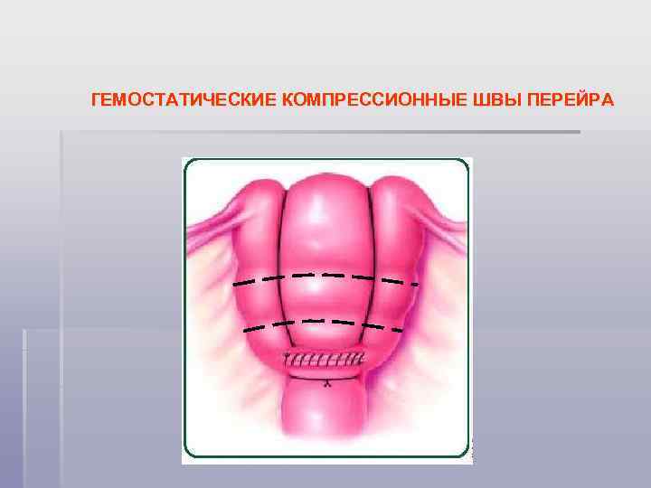 ГЕМОСТАТИЧЕСКИЕ КОМПРЕССИОННЫЕ ШВЫ ПЕРЕЙРА 