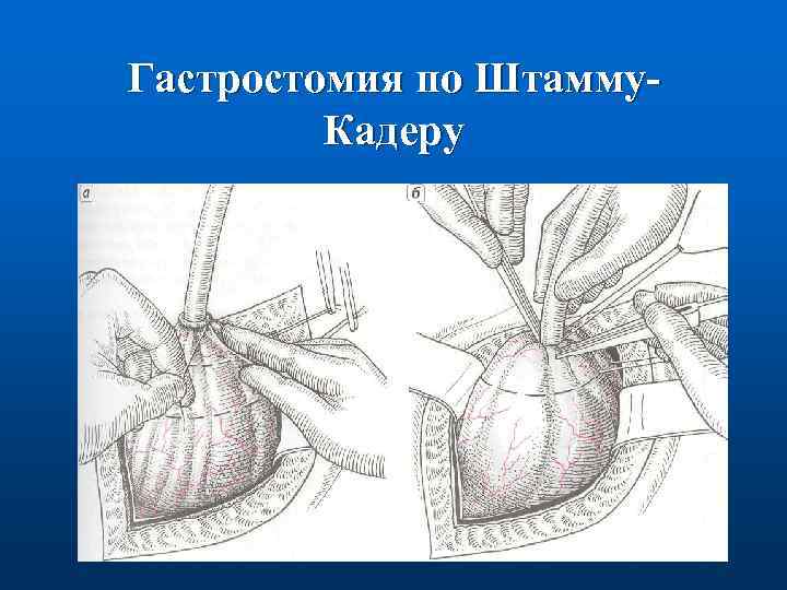 Виды гастростомии