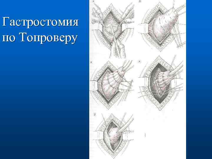 Шов после операции на желудке фото