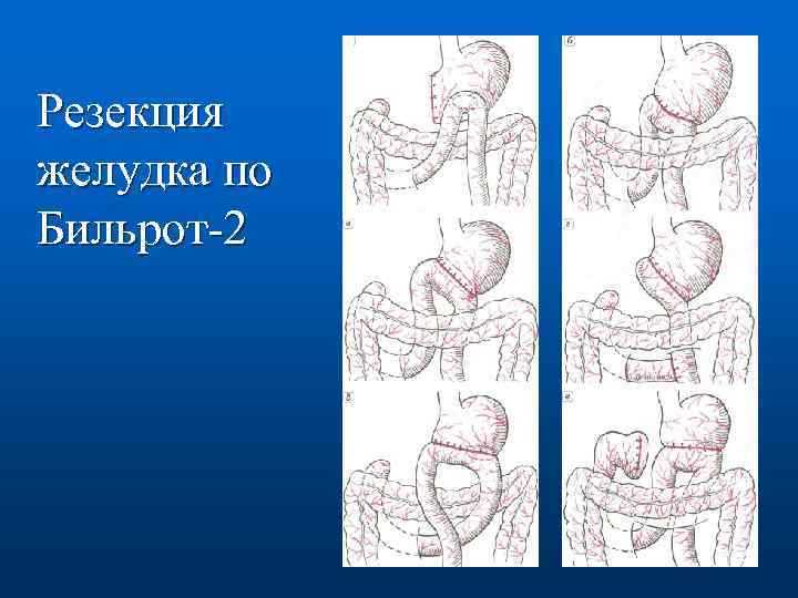 Резекция желудка по витебскому схема операции