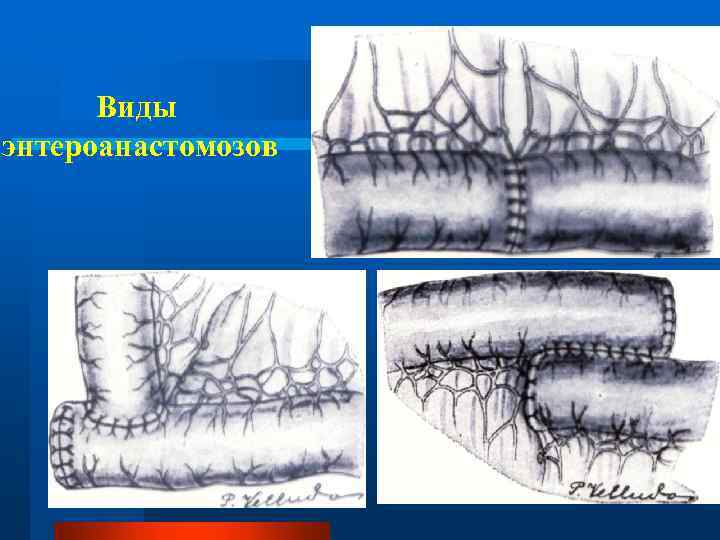 Несостоятельность послеоперационного шва карта вызова