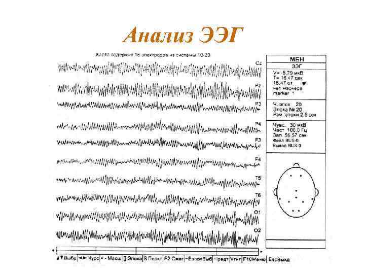 Анализ ЭЭГ 