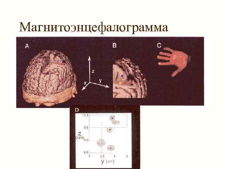 Магнитоэнцефалограмма 