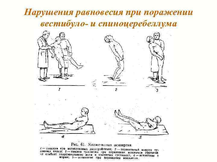 Нарушения равновесия при поражении вестибуло- и спиноцеребеллума 