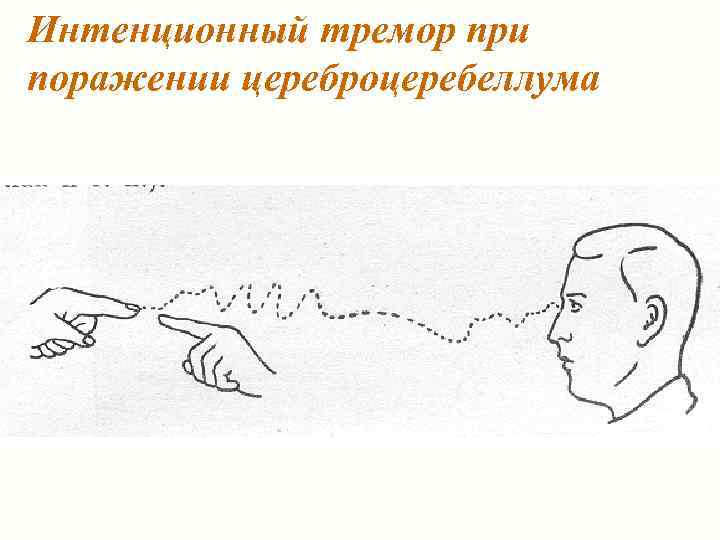Интенционный тремор при поражении цереброцеребеллума 