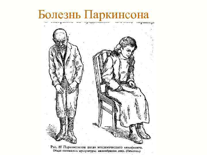 Болезнь Паркинсона 