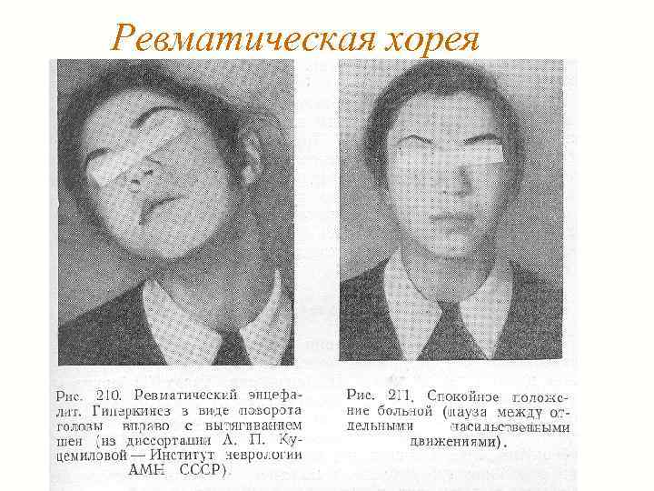 Ревматическая хорея 