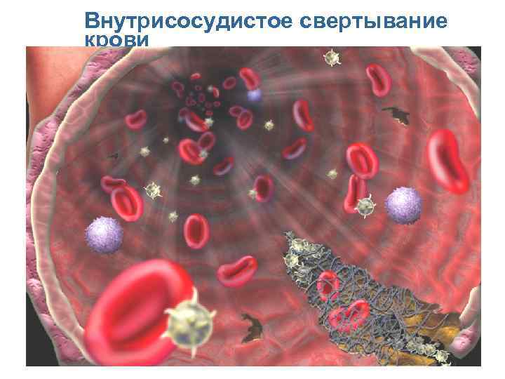 Внутрисосудистое свертывание крови Перейти на первую страницу 