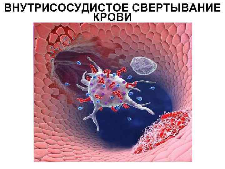 ВНУТРИСОСУДИСТОЕ СВЕРТЫВАНИЕ КРОВИ Перейти на первую страницу 