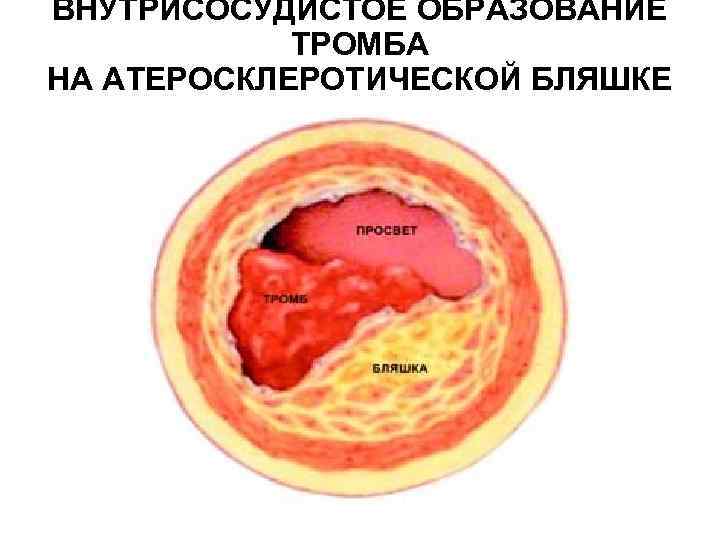 ВНУТРИСОСУДИСТОЕ ОБРАЗОВАНИЕ ТРОМБА НА АТЕРОСКЛЕРОТИЧЕСКОЙ БЛЯШКЕ Перейти на первую страницу 